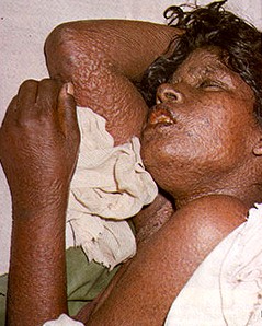 Flat Type Smallpox